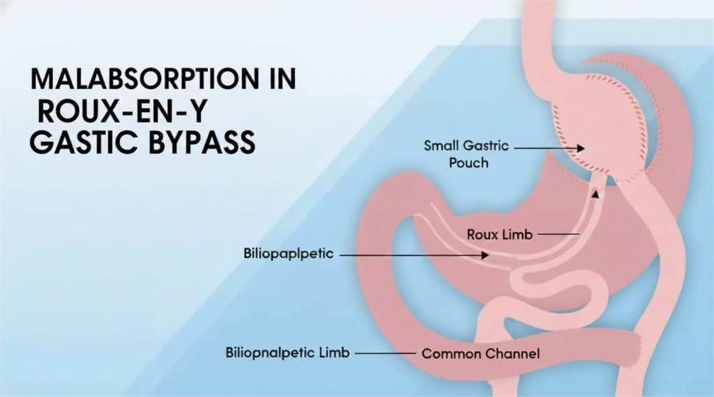 malabsorption in Roux-en-Y gastric Bypass