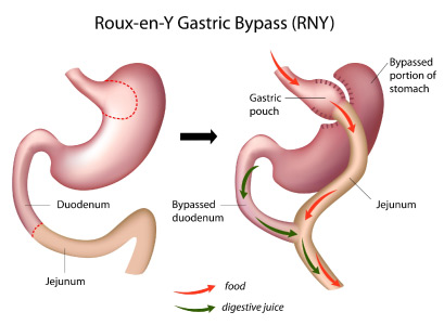 anastomosis in roux-en-Y gastric bypass illustration