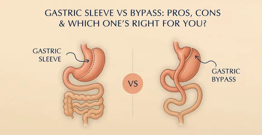 gastric bypass vs gastric sleeve illustration