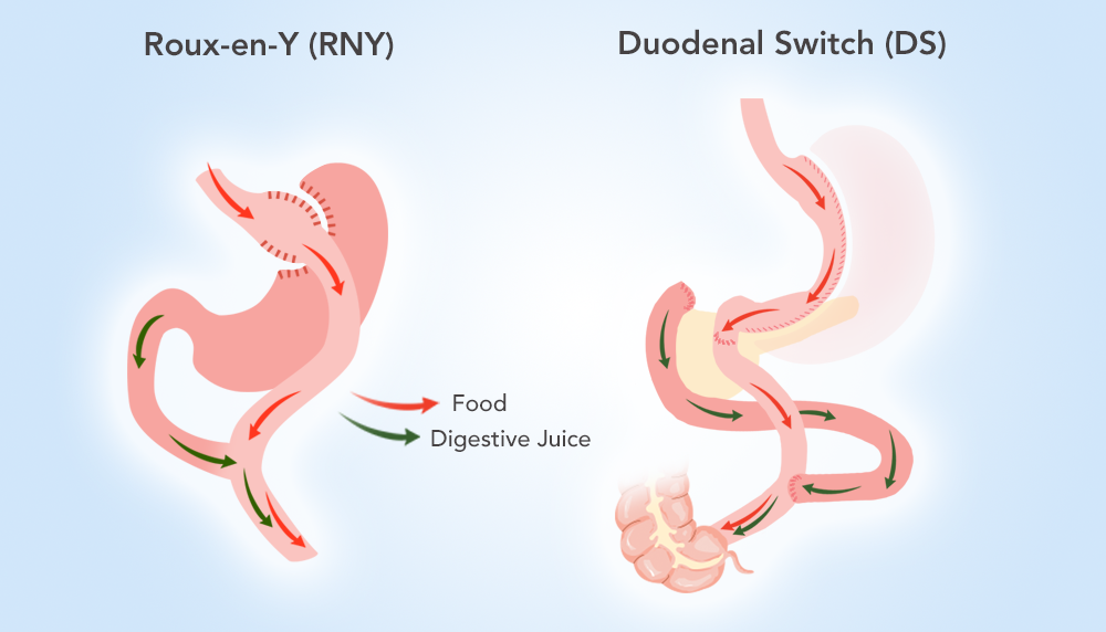 duodenal switch vs roux-en-y gastric bypass illustration