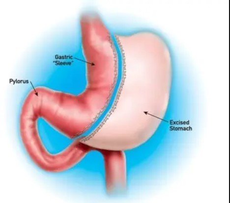vertical sleeve gastrectomy illustration
