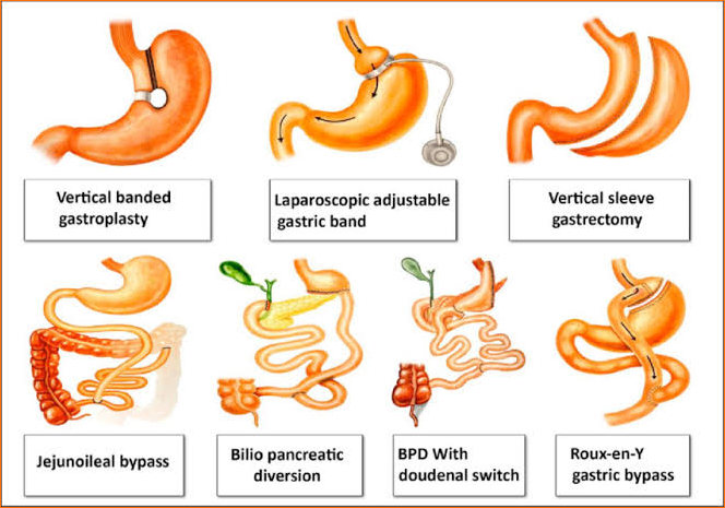 types of bariatric surgery procedures illustration
