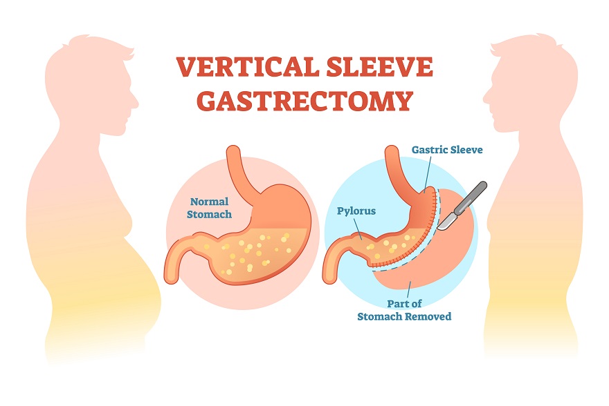 vertical sleeve gastrectomy illustration
