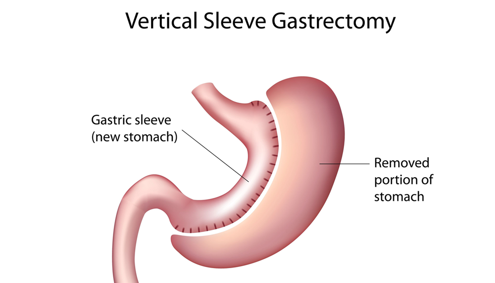 vertical sleeve gastrectomy illustration