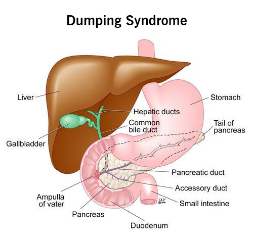 dumping syndrome labeled diagram illustration