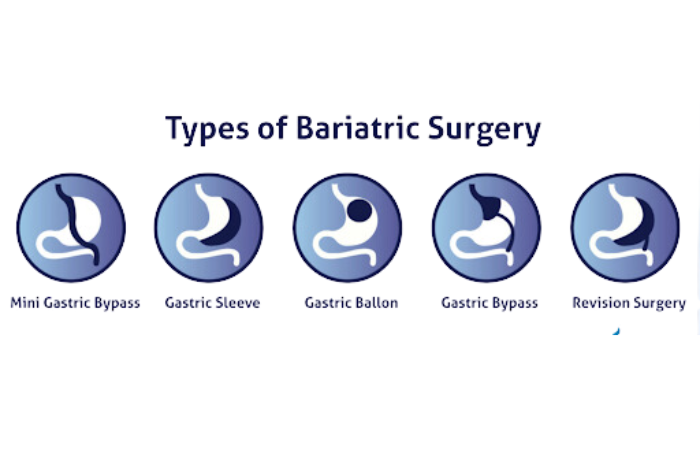 types of bariatric surgery