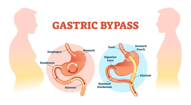 gastric bypass illustration