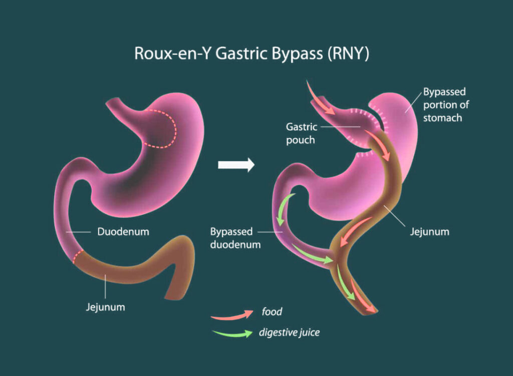 labeled illustration of roux-en-Y gastric bypass