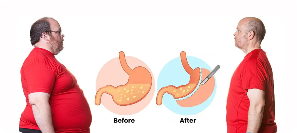 bariatric surgery results